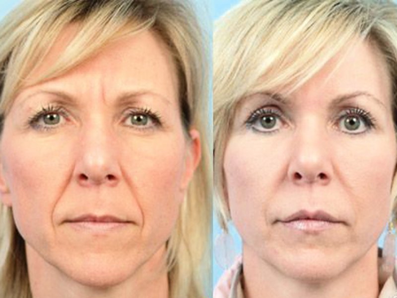 Чтобы кожа была без угрей и морщин, женщина готовит эту простую болтушку. Результат уже через 10 минут!