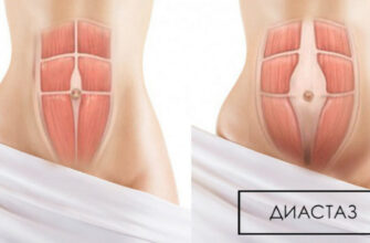 Упражнения от диастаза, от обвисания живота для женщин.