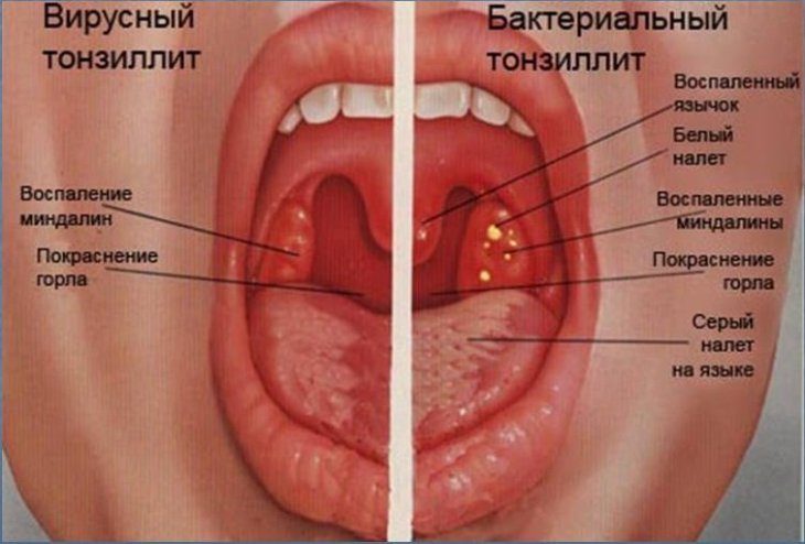 Как избавиться от ангины и боли в горле быстро? Старый домашний рецепт-вылечит на раз, два…Видео-всё про ангину!