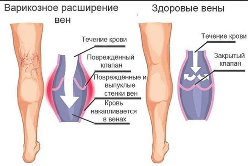 Как я глиной варикоз вылечила — вот такое простое средство!